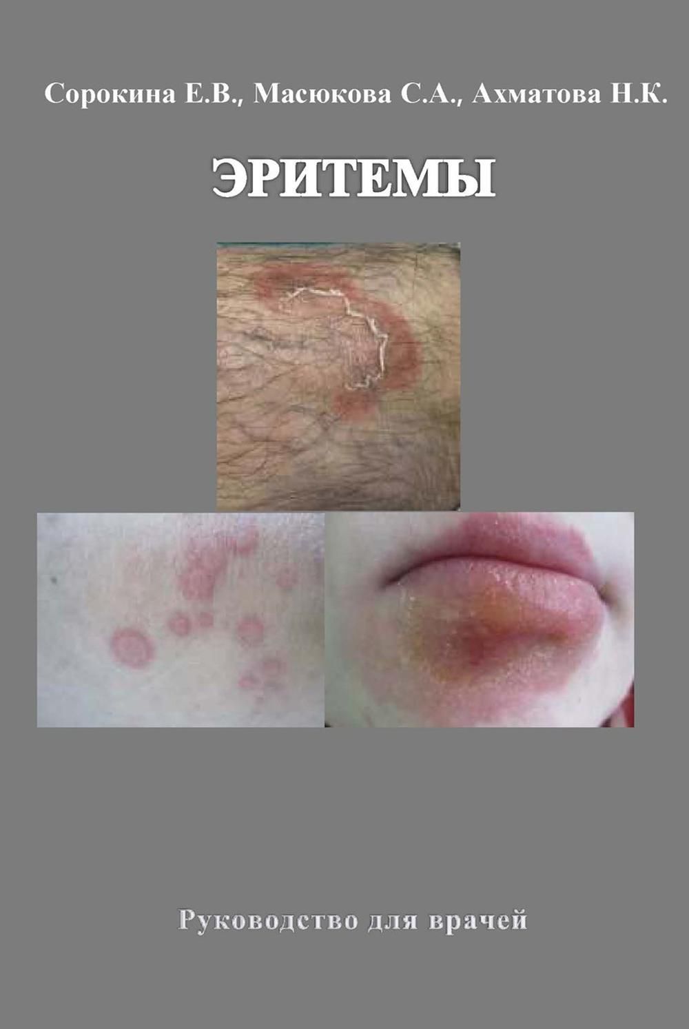 Эритемы. Руководство для врачей. Ахматова Н.К., Масюкова С.А., Сорокина Е.В. Эритемы. Руководство для врачей. Ахматова Н.К., Масюкова С.А., Сорокина Е.В.